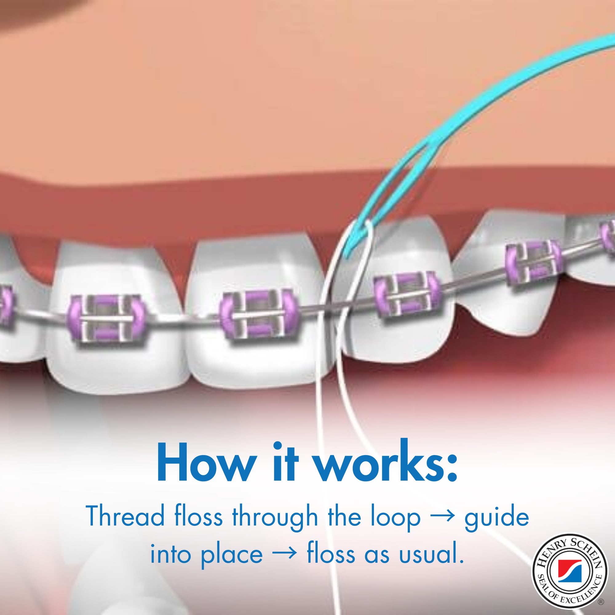 Acclean Floss Threaders, Dental Floss Threaders for Bridges, Orthodontic Appliances & Implants