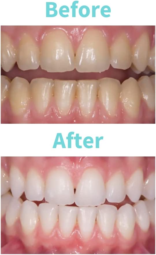 White Dental Beauty Teeth Whitening Syringe Gel Refills; 4 Syringes of 1.2 ml per Pack. Tooth Whitening System Powered by Novon Technology (10% Carbamide Peroxide)