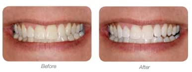 LumiSmile White Take-Home Teeth Whitening Treatment Syringes; Two (2) 2.5 ml Syringes of 16% Carbamide Peroxide Whitening Treatment