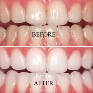 Natural Elegance® Plus 22% Carbamide Peroxide Mint Flavor Teeth Whitening Gel by Henry Schein, Two 3-ml Syringes, Compare to Opalescence, Dramatic Professional Whitening, Reduced Sensitivity