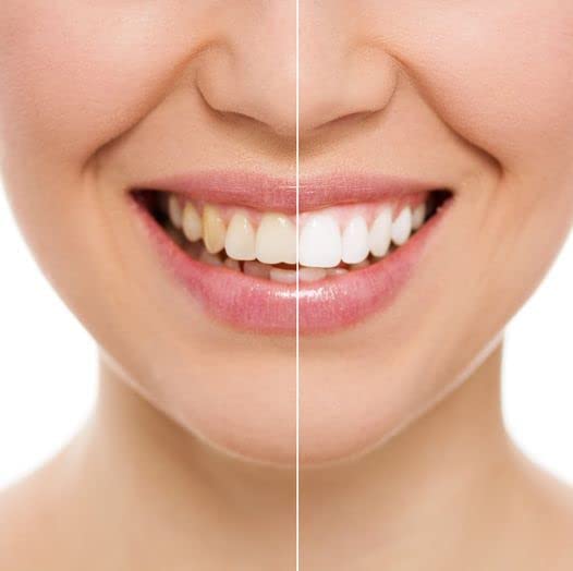 LumiSmile White Take-Home Teeth Whitening Treatment Syringes; Two (2) 2.5 ml Syringes of 16% Carbamide Peroxide Whitening Treatment